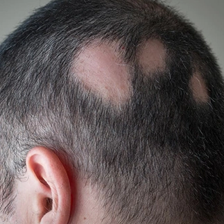 platelet rich plasma therapy for hair loss